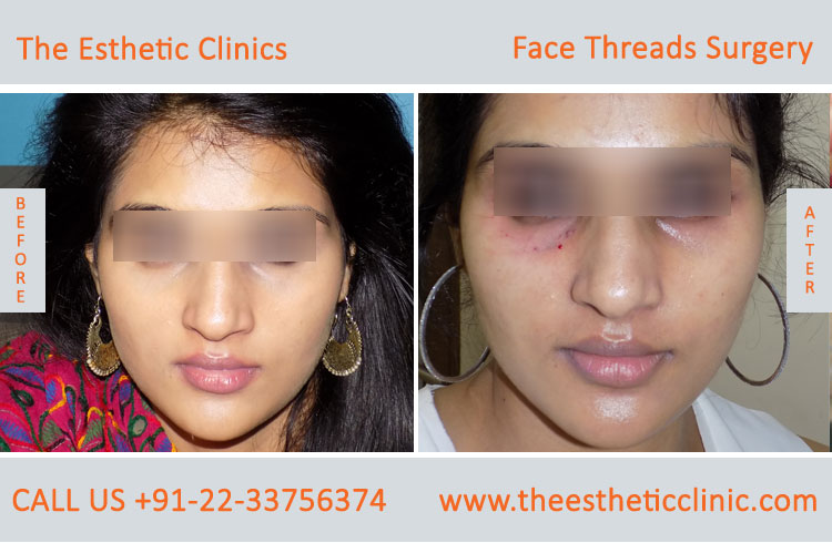 thread facelift, face lifting with threads treatment before after photos in mumbai india (9)